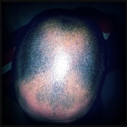 28th Feb 2012 - Bald and shiny