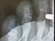10th Mar 2012 - Broken Toe ( Middle Toe, Middle Joint - crack)