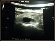 14th Mar 2012 - Cyst Biopsy - ouch!