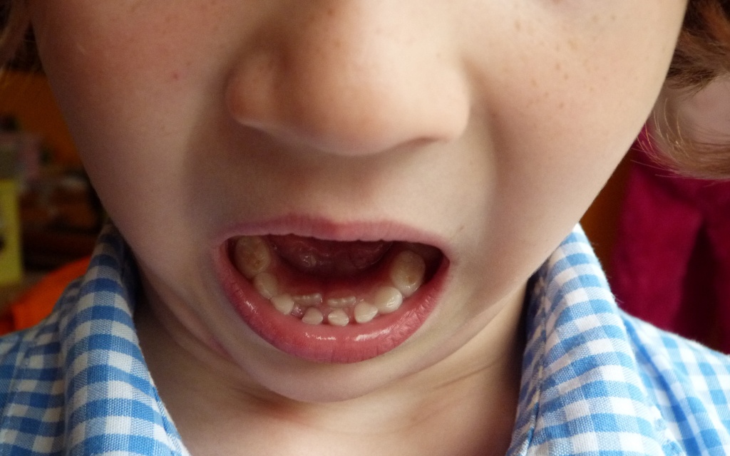 Diary: First wobbly tooth by calx