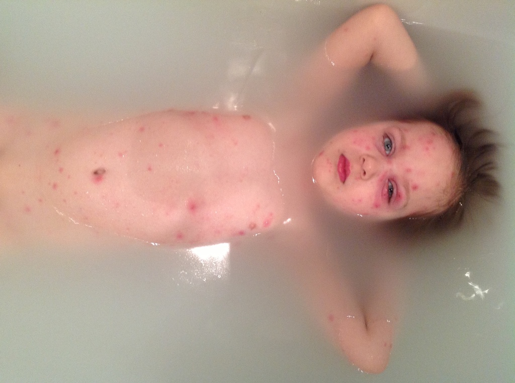 My poor baby with Chickenpox.  by tallgate