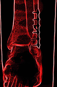 31st Oct 2013 - Skeletal Ankle 