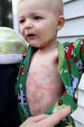 30th Mar 2014 - Severe Allergic Reaction to Penicillin