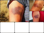 26th May 2015 - Day 13 - Rhoda's Bruise