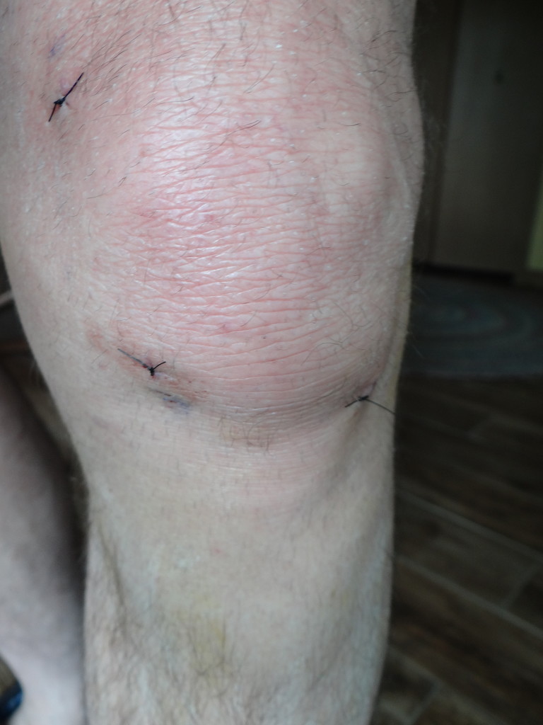 Gross, Ugly, Repaired Knee by brillomick
