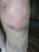 6th Jun 2015 - Gross, Ugly, Repaired Knee