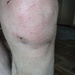 Gross, Ugly, Repaired Knee by brillomick