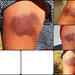 Day 13 - Rhoda's Bruise Update by terryliv