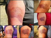 26th Jul 2015 - Day 17 - Last Look at Rhoda's Bruise