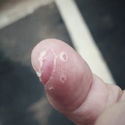 19th Aug 2015 - Still a Pain in My Finger