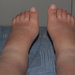 Swollen ankles by seacreature