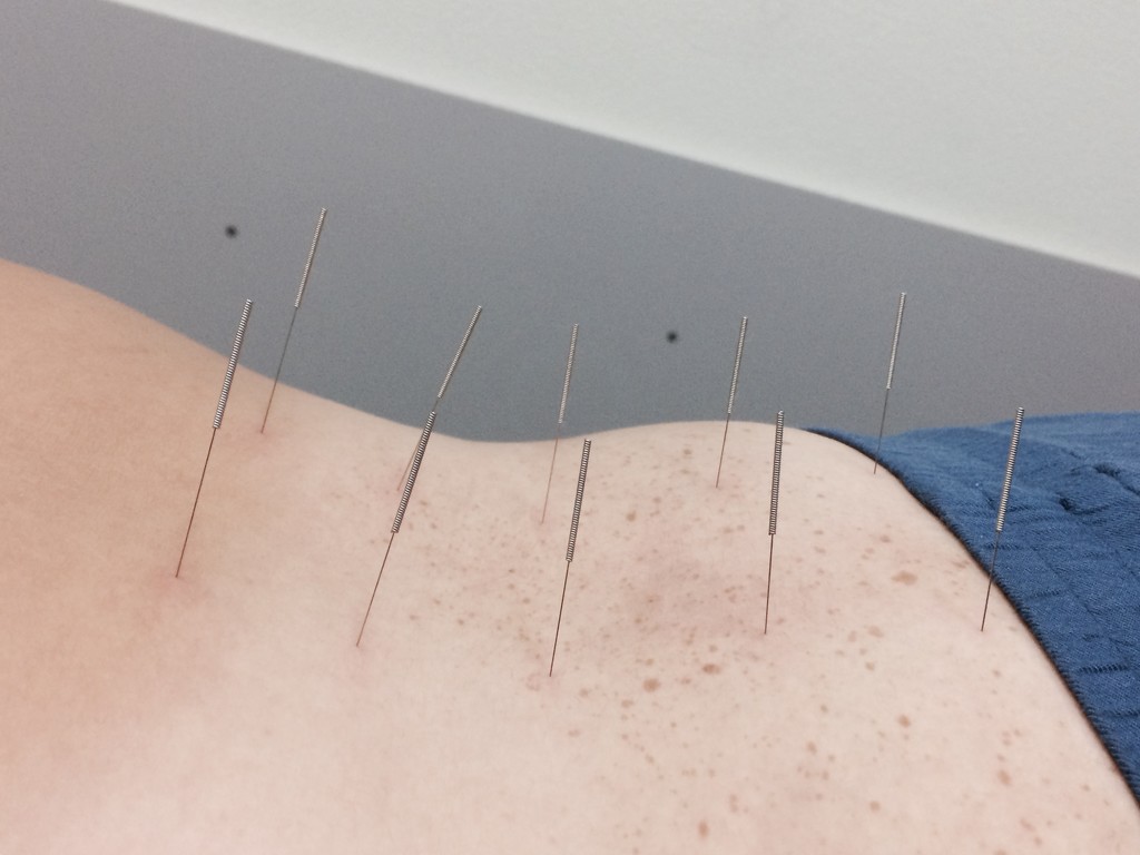 First Acupuncture  by sarahabrahamse