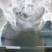 Total Hip Replacement X-Ray by harbie