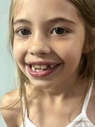 28th Jul 2019 - Tooth #7 gone 