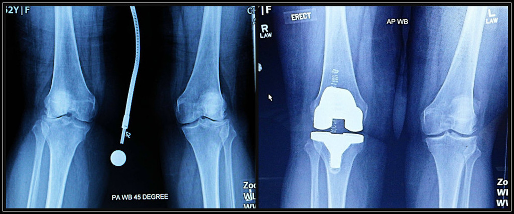 Knee X-Rays by olivetreeann