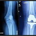 Knee X-Rays by olivetreeann