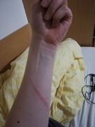 19th Feb 2021 - I burned my hand on hot oil
