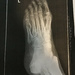 Fifth Metatarsal Pulverized