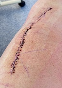 9th Apr 2024 - Suture line well overc50clipscto be removed in about 6 days 