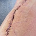Suture line well overc50clipscto be removed in about 6 days 