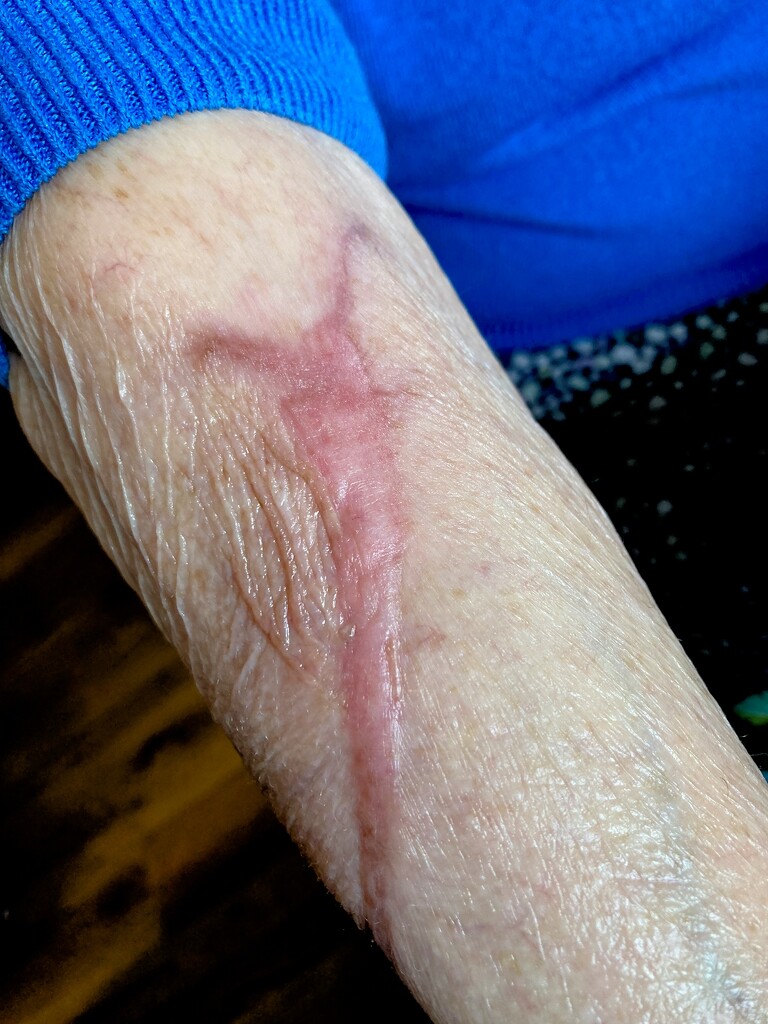 Beryl's scar, slug or a scorpion! by allsop
