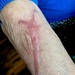Beryl's scar, slug or a scorpion!