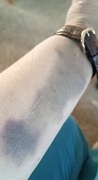 31st Jan 2025 - Pre-surgery Souvenir...