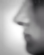 19th Feb 2025 - Rhinoplasty 