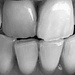 Tombstone teeth 