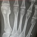 Broken little toe