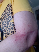 23rd Aug 2025 - Burn 